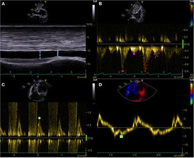Multiparametric vs. Inferior Vena Cava–Based Estimation of Right Atrial Pressure